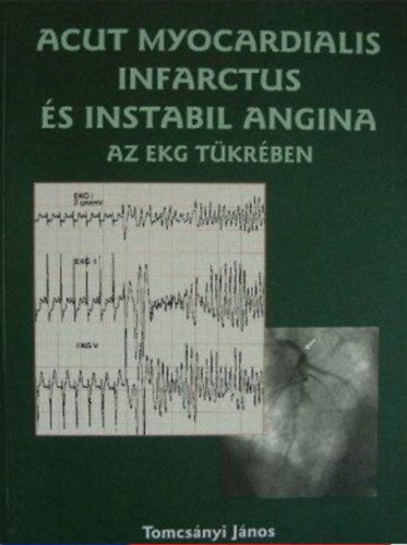 Tomcsnyi Jnos - Acut myocardialis infarctus s instabil angina az EKG tkrben